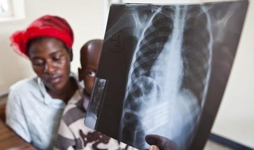 Milyen tünet a gyermekek tuberkulózisát tekintik a betegség kialakulásának?