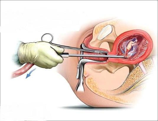 műtéti abortusz értékelés
