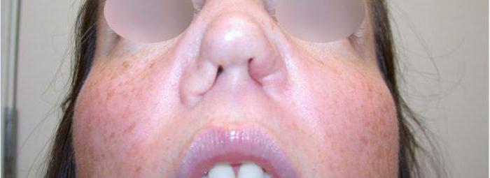 Az orrszeptum perforációja: okai, tünetei, kezelési módszerei és következményei